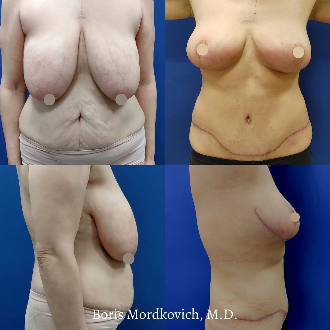 Before and after breast lift results by Dr. Boris Mordkovich, showing frontal, side, and profile views